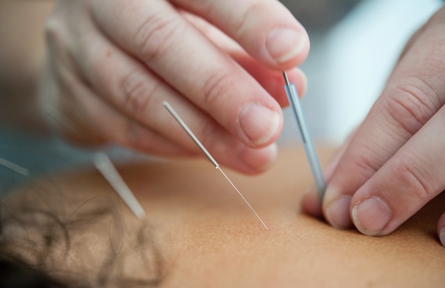 Acupuncture For Migraines